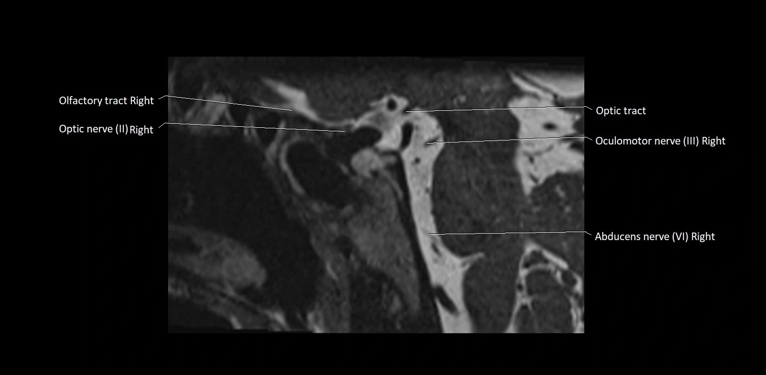 Cranial nerve sagittal anatomy MRI 3T image 37.webp